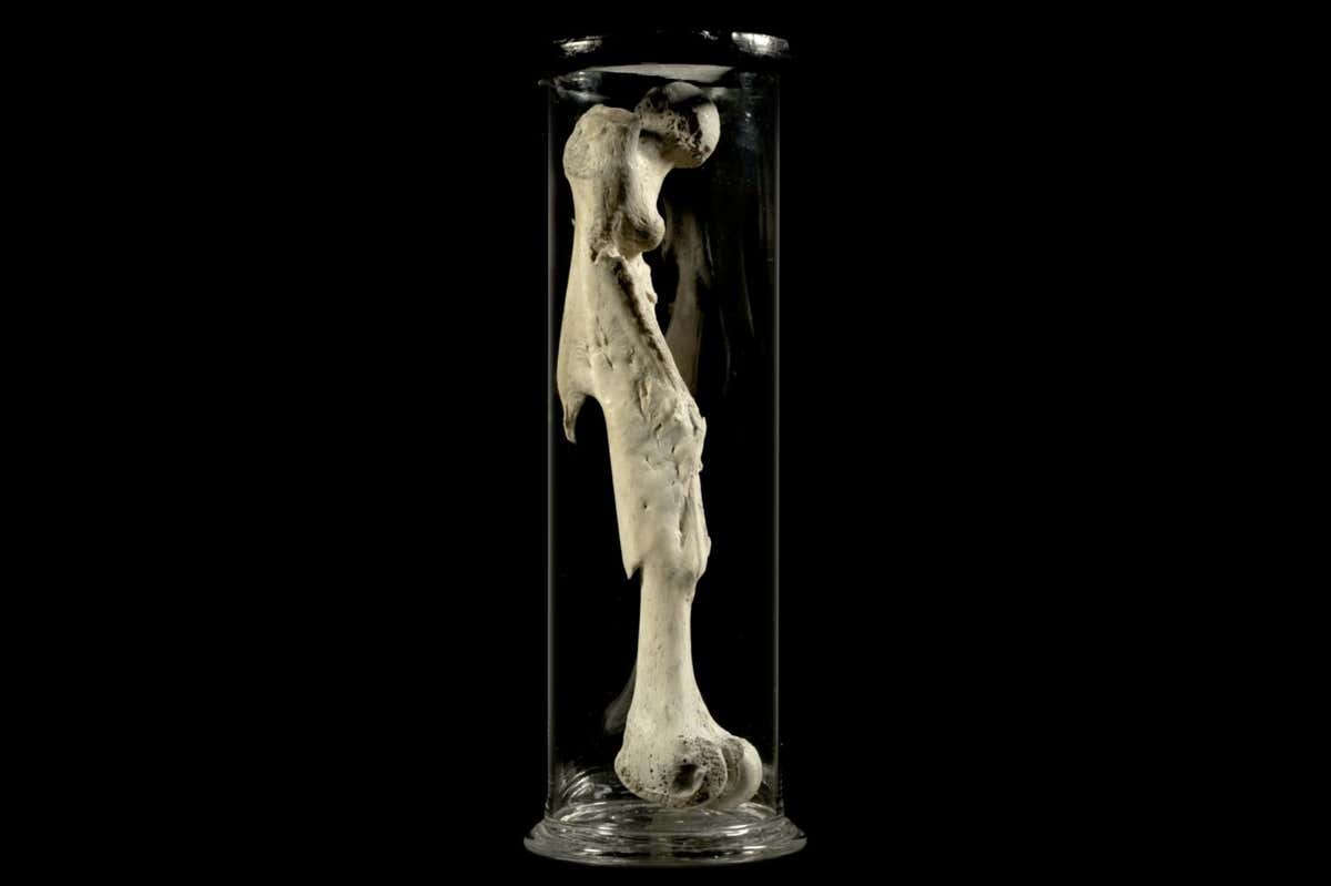 P525 - Human femur, with a severe fracture united by new bone, prepared by John Hunter between 1760 and 1793