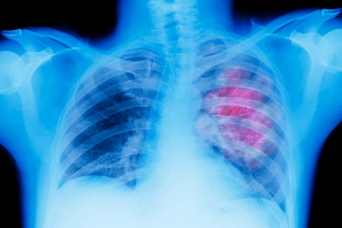 X-ray of lung showing chest cancer