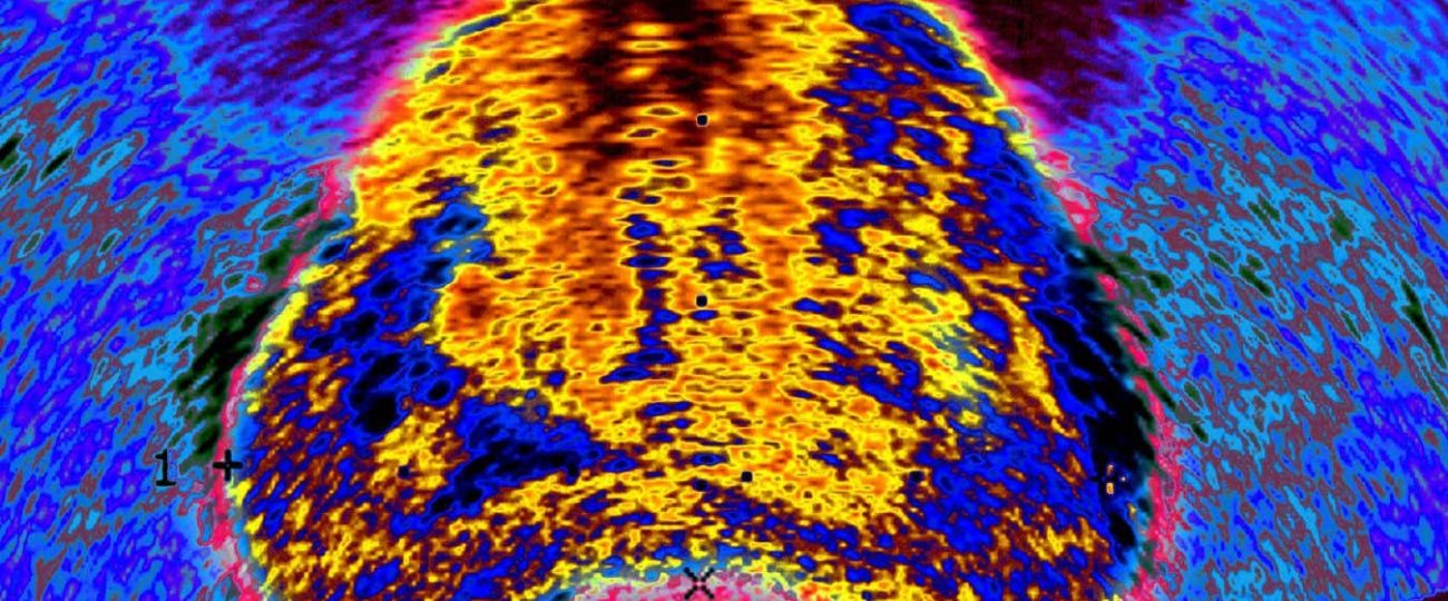 We are finally improving prostate cancer diagnoses – here’s how