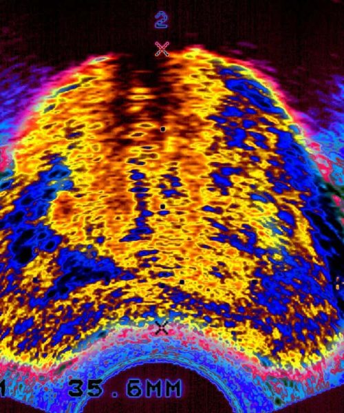 We are finally improving prostate cancer diagnoses – here’s how