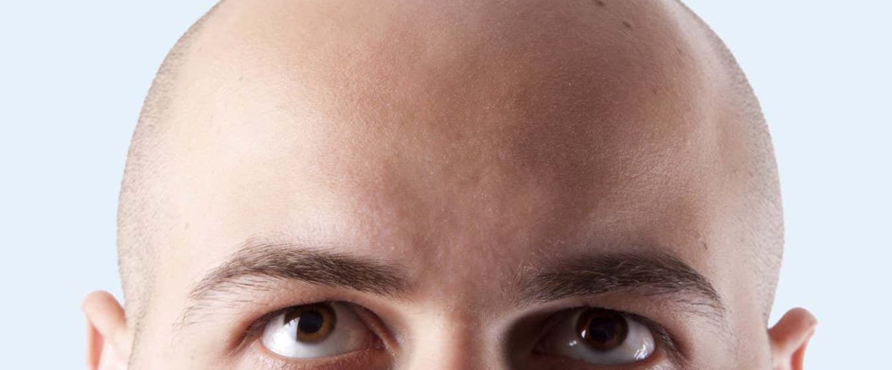 Can we finally reverse balding with these new experimental treatments?