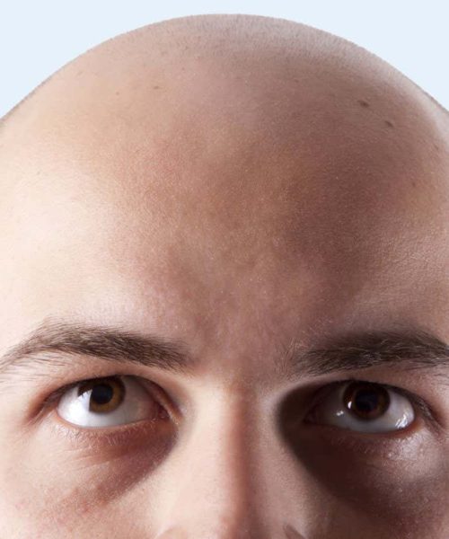 Can we finally reverse balding with these new experimental treatments?