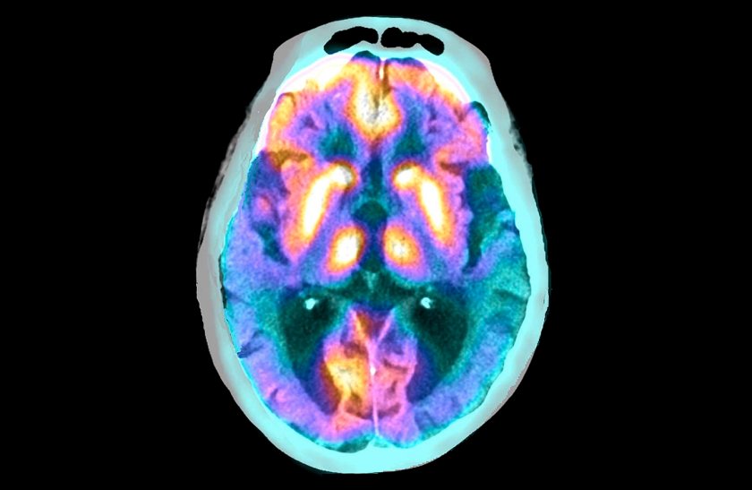 Alzheimer's disease. Coloured combined positron emission tomography (PET) and computed tomography (CT) scan of the brain of a 62-year-old woman who was diagnosed with Alzheimer's disease four years previously. The front of the brain is at top. Alzheimer's is a neurodegenerative disease and a common cause of dementia in the elderly. It is caused by the formation of protein plaques in the brain, which kill surrounding neurons. The cause of these plaques is not known and there is no cure. The CT scan shows cortical atrophy and dilatation of the ventricles. The PET scan (using the radioisotope-labelled fludeoxyglucose) shows low metabolic activity (absence of yellow areas) in the temporoparietal cortex in both hemispheres of the brain.